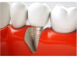 4 By 4 Dental Implants Las Vegas